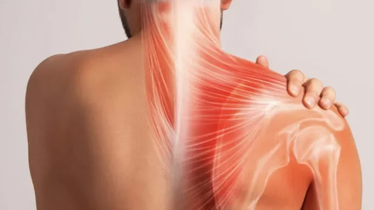 fisioterapi frozen shoulder Jakarta
